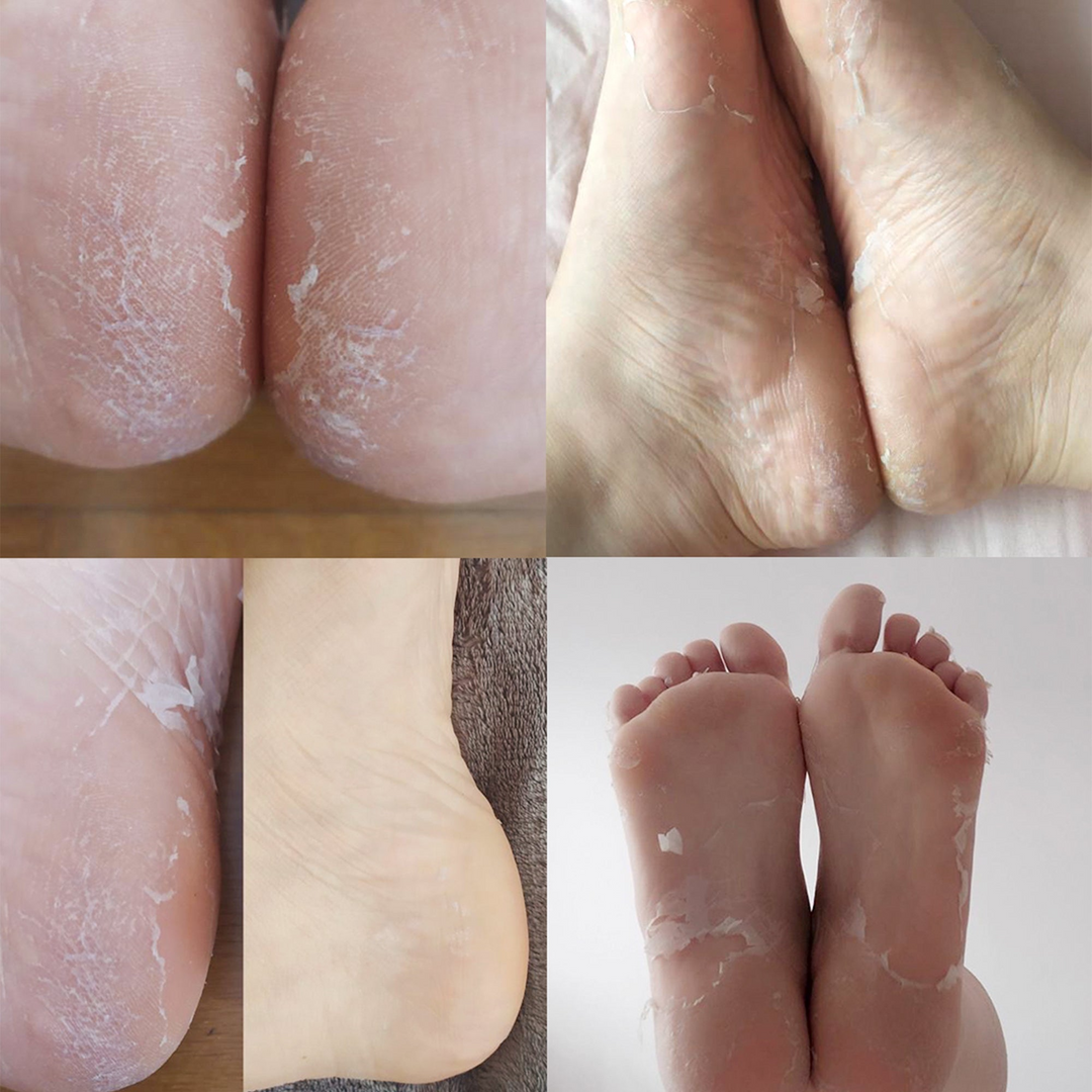 Calcetines Exfoliantes y Peeling con Ácido Glicólico